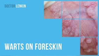 😕 Warts on foreskin [upl. by Auhsuj]