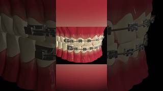 Dental Braces dentist medicalanimation [upl. by Notyarb]