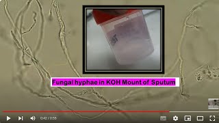 Fungal branched hyphae in KOH mount of Sputum Microscopy [upl. by Ayotaj696]