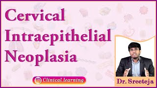 50 Cervical Intraepithelial Neoplasia [upl. by Suoirrad]