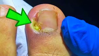 The WORST Infected Toenail Removal Youve Ever Seen [upl. by Enorej]