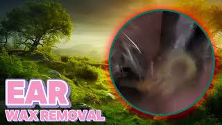 Shocking Truth About​​ What Your Cerumen Says About Your Health [upl. by Imit191]