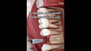 quotRecupera tu sonrisa y confianza con un implante dental la solución permanente para una dentadura [upl. by Abroms]