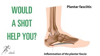 Should you get a cortisone shot for plantar fasciitis [upl. by Pietje]