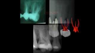 Primer molar superior [upl. by Alleacim]