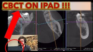 How to Open CBCT on the Ipad and Read any Radiographs and DICOM files cbct oralradiology [upl. by Cassi]