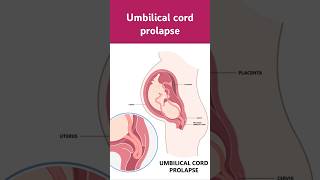 What Happens During UMBILICAL CORD Prolapse pregnant pregnancy nowtrending October 23 2024 [upl. by Bette]