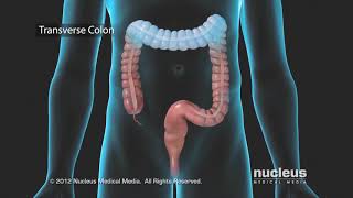 Colon Problems Diverticular Disease [upl. by Akemor258]