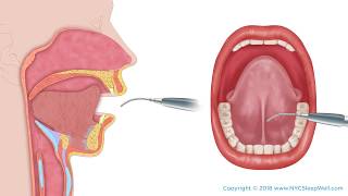 Frenectomy Tongue Tie Procedure [upl. by Adia]