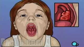 Tonsillectomy Surgery PreOp® Patient Education Medical Video [upl. by Questa52]