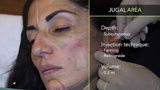 ELLANSÉ™  Full face injection video Dr F de Melo APPROVED [upl. by Rodmur396]