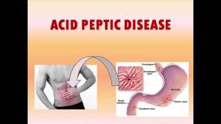 Acid Peptic Disease Presentation [upl. by Nyrehtak]