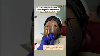 Mesoterapia Capilar Mesoterapia con Dutasteride para alopecia mesoterapia hair cabello salud [upl. by Assirahc]