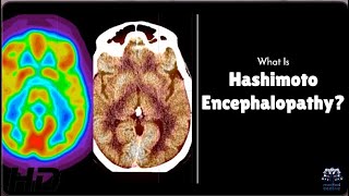 Hashimoto Encephalopathy Is Your Brain at Risk [upl. by Nudnarb]