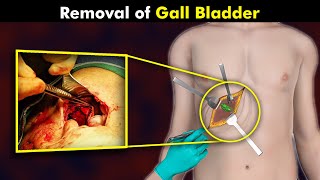 How Cholecystectomy Procedure Is Performed  Gallbladder Removal Surgery UrduHindi [upl. by Arber541]