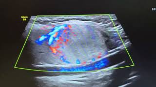 Ultrasound of hyperplastic adenomatous nodule in right lobe of thyroid [upl. by Otsuaf927]