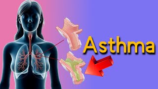 How to Detect Asthma Top 5 Signs and Symptoms asthma causes and treatment [upl. by Lihkin]