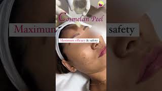 Say Goodbye to pigment with Cosmelan Peel Treatment pigmentation cosmelan [upl. by Anim458]