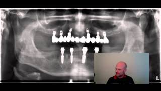 Oberkiefer Implantate auch ohne Knochenaufbau möglich [upl. by Nnaytsirk]