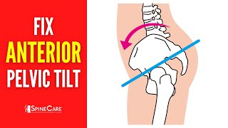 How to Fix Your Anterior Pelvic Tilt  STEPBYSTEP Guide [upl. by Brookhouse]