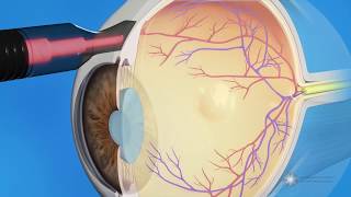 CPC for Glaucoma Treatment [upl. by Maynard322]