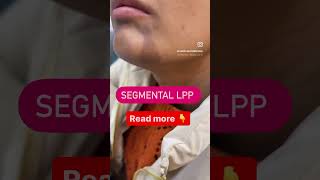 Segmental lichen Planus Pigmentosus Treatment drashimagoel skincare parisaskinclinic [upl. by Ivek293]