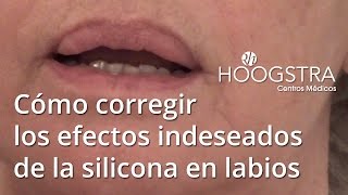 Cómo corregir los efectos indeseados de la silicona en labios 16019 [upl. by Aicaca]