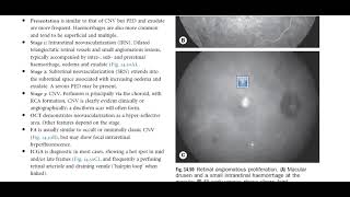 Kanski Clinical Ophthalmology Made Easy  Macula 7 PCV  RAP [upl. by Eanat]