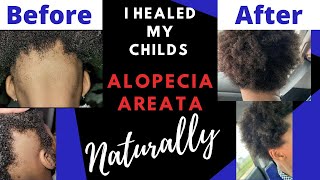 HOW I HEALED MY DAUGHTERS ALOPECIA AREATA NATURALLY🤯 CURE ALOPECIA‼️ HAIR REGROWTH TREATMENT 2024 [upl. by Cathryn837]