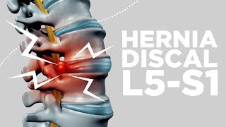 HERNIA DISCAL L5S1 síntomas y soluciones [upl. by Eerased]