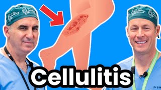 Cellulitis Explained By Infectious Disease Doc Red Sore And Swollen [upl. by Colet838]