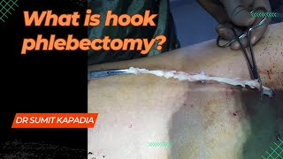 The Ultimate Guide to Hook Phlebectomy Say Goodbye to Varicose Veins [upl. by Butler664]