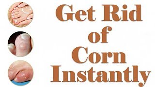 Corn Treatment  How to Get Rid of Corn on Foot  Corn Removal [upl. by Eellehs]