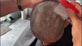 How to get rid old dandruff flakes scratching super care 🥵😱💯 how to get rid of dry scaly skin [upl. by Procto993]