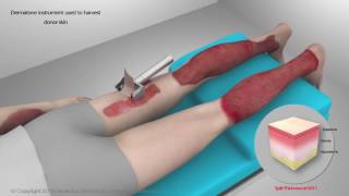 Skin Graft Procedure  Flash Fire Injury [upl. by Sidra]