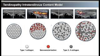 Tendinosis and the role of Minimally Invasive Tenotomy [upl. by Ecargyram]