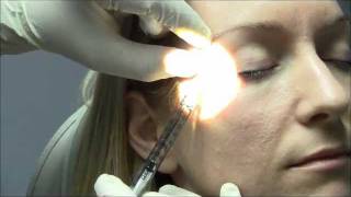 Dysport Injections Performed by Dr Vijay Sharma [upl. by Egoreg]