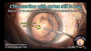 CataractCoach 1390 CTR insertion with cortex still in bag [upl. by Neeruam178]