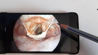 Anatomy of Laryngopharynx HypopharynxENT [upl. by Llennor]