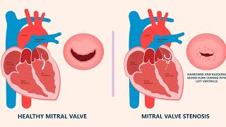 Mitral Stenosis [upl. by Proctor917]