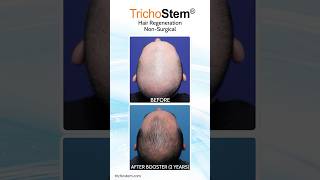 Other ACellPRP Vs TrichoStem Hair Regeneration Cost and Treatment Frequency hairloss [upl. by Okomom]