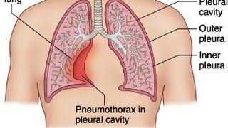 Pneumothorax [upl. by Aivilys826]