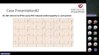 Frequent Ventricular Ectopy Defining Outcomes When and How to Treat with Michael Thibert MD [upl. by Nosirrah]