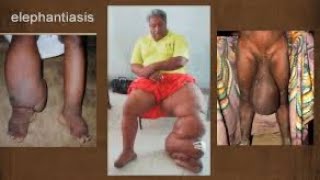 Comment soigner naturellement l’ELEPHANTIASIS [upl. by Rednasxela]