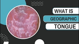 What is Geographic Tongue Causes Symptoms and Management [upl. by Reiser]