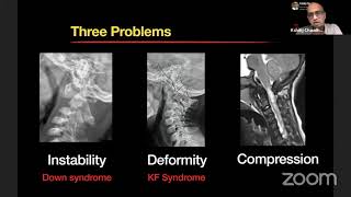 Atlantoaxial Dislocation in Downs Syndrome [upl. by Notseh448]