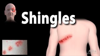 Shingles Pathophysiology Symptoms 3 stages of Infection Complications Management Animation [upl. by Stenger931]