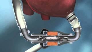 HeartMate II Left Ventricular Assist System  MyLVAD [upl. by Dolph]