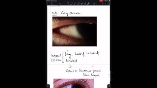 Case 7 Xerophthalmia Vitamin A Deficiency [upl. by Odelinda]