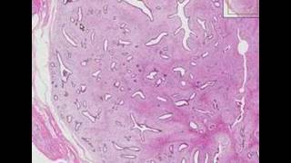 Histopathology Breast Fibroadenoma [upl. by Aicatan271]